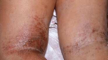 Atopic eczema