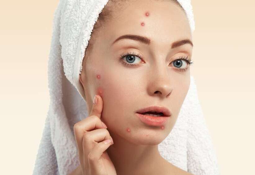 Acne & Acne Scar Treatment